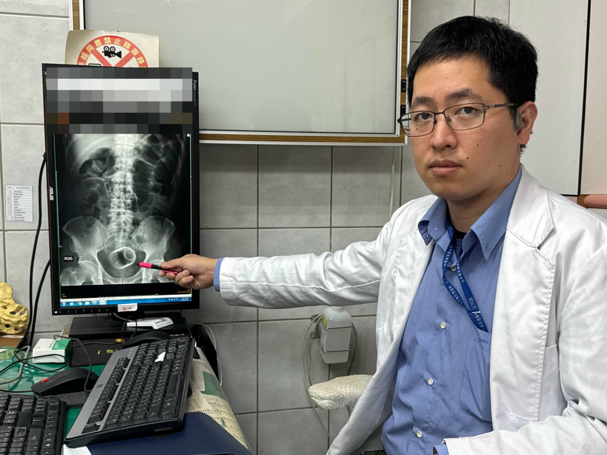 男3天無法嗯嗯　竟是瓷杯塞「菊花」惹...