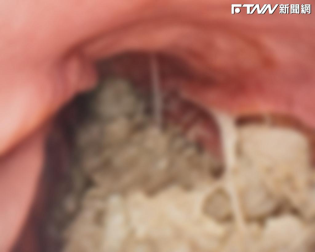 打瘦瘦針致胃癱瘓！醫照胃鏡驚見食物塞...