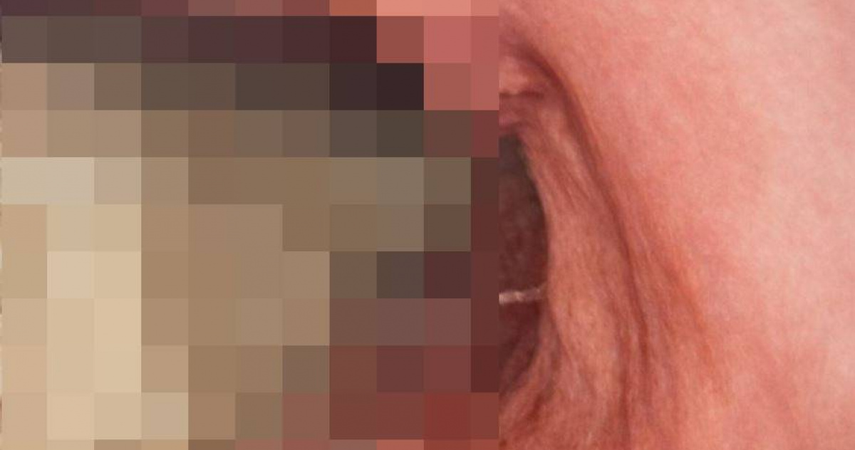 女打瘦瘦針下場慘！空腹12小時「殘渣塞滿腹」　醫曝驚悚畫面：胃癱瘓了